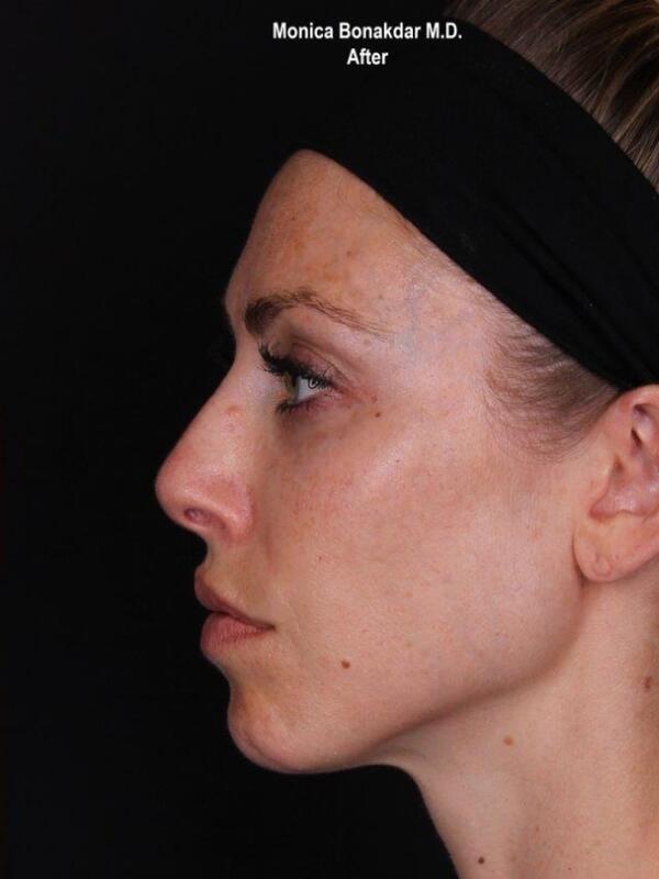 Nonsurgical Nose Job Before & After Photo