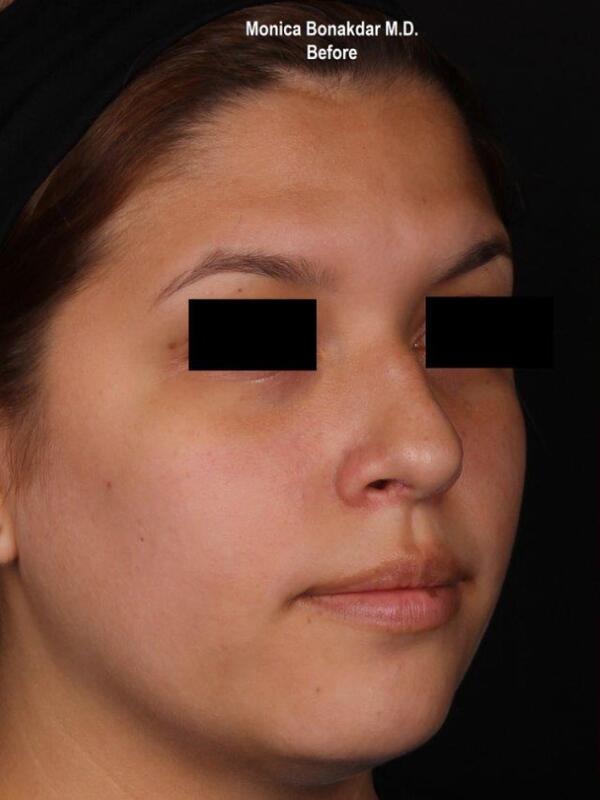 Nonsurgical Nose Job Before & After Photo