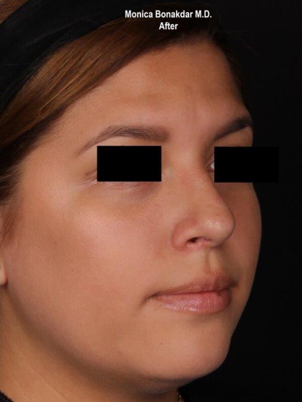 Nonsurgical Nose Job Before & After Photo