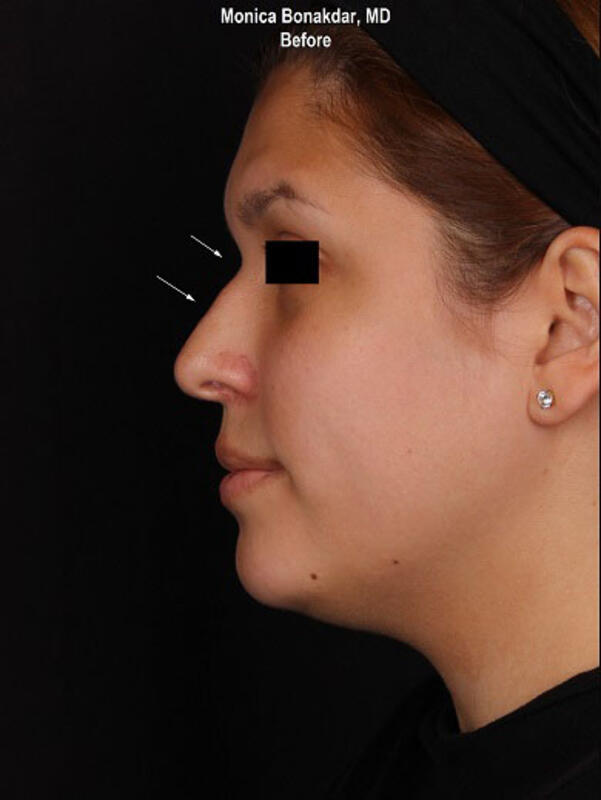 Nonsurgical Nose Job Before & After Photo