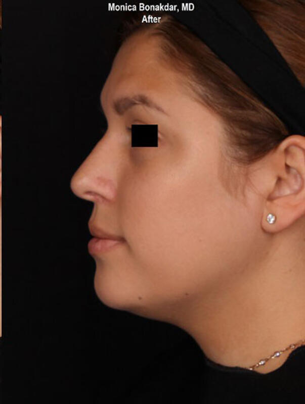 Nonsurgical Nose Job Before & After Photo