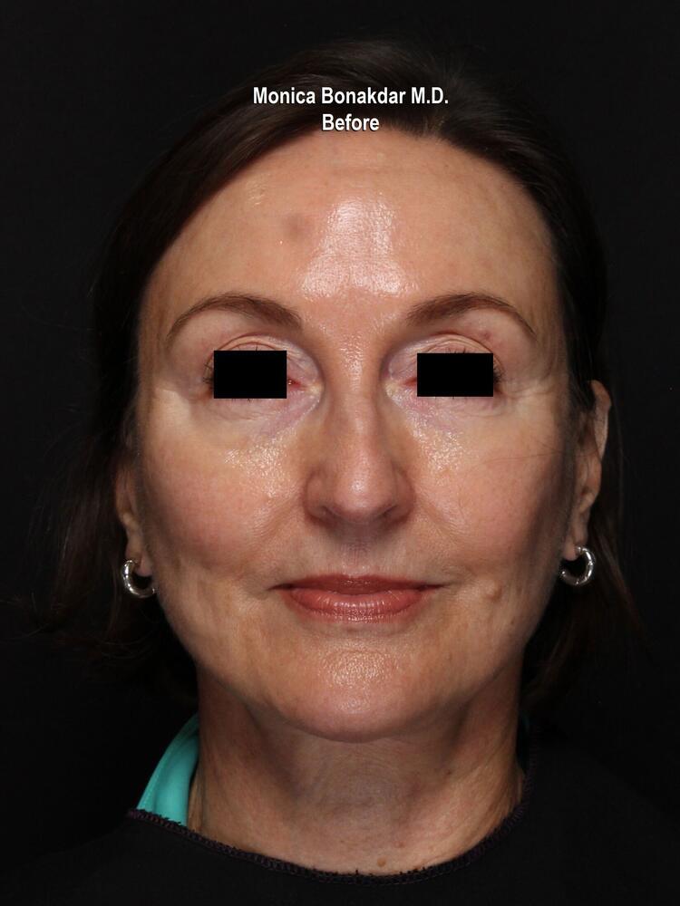 Sunken Eyes: Moderate Before & After Photo