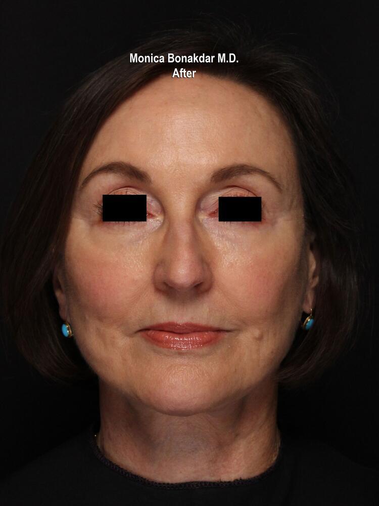 Sunken Eyes: Moderate Before & After Photo