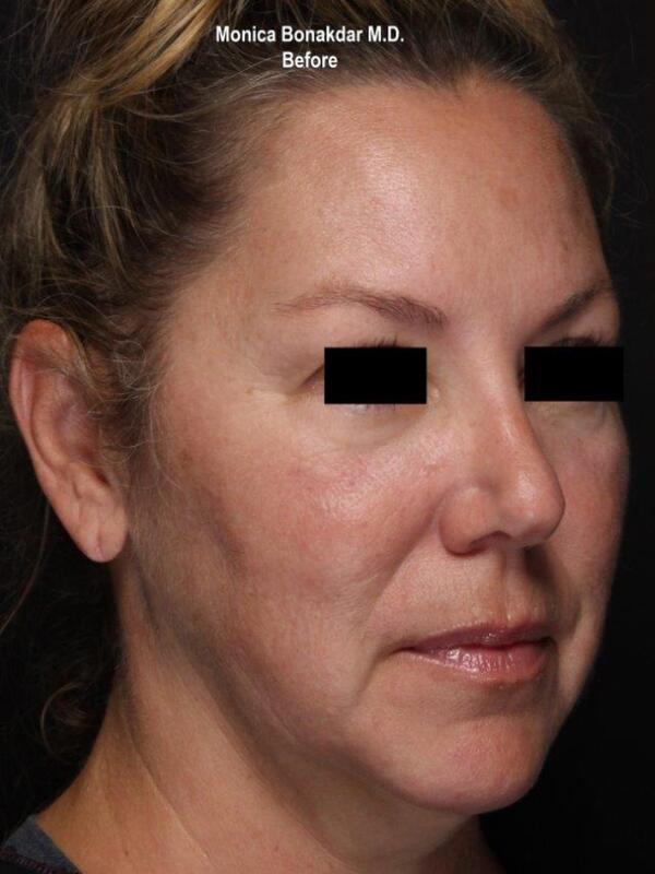 Sunken Eyes: Moderate Before & After Photo