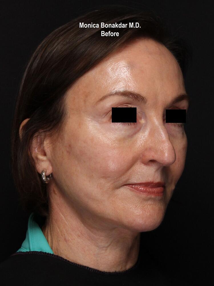 Sunken Eyes: Moderate Before & After Photo