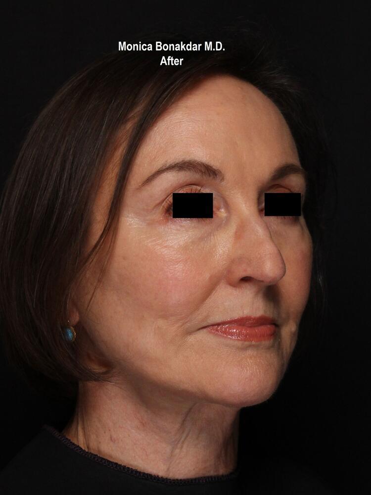 Sunken Eyes: Moderate Before & After Photo