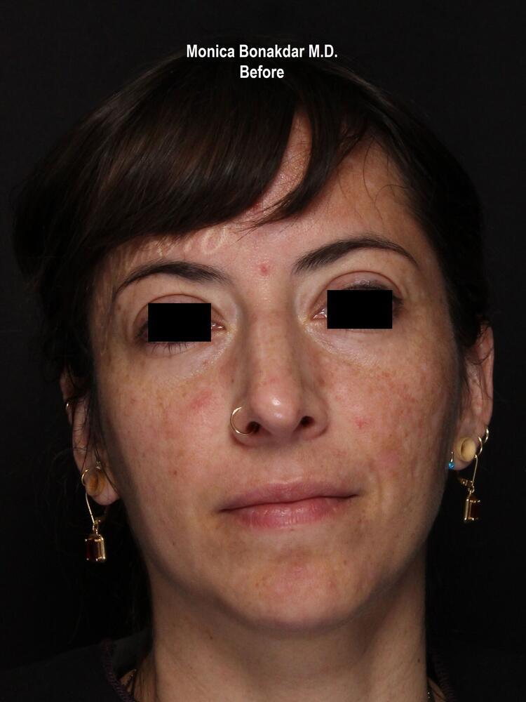 Sunken Eyes: Moderate Before & After Photo