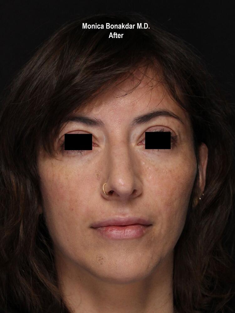 Sunken Eyes: Moderate Before & After Photo