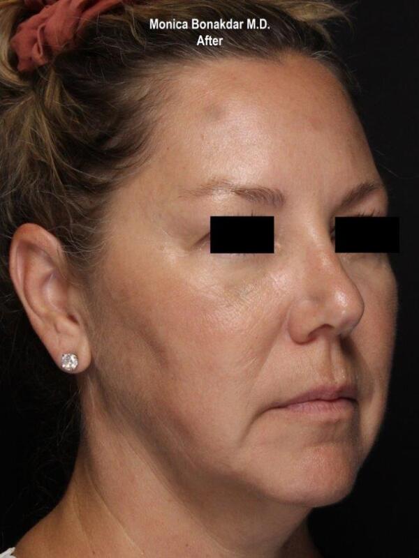 Sunken Eyes: Moderate Before & After Photo