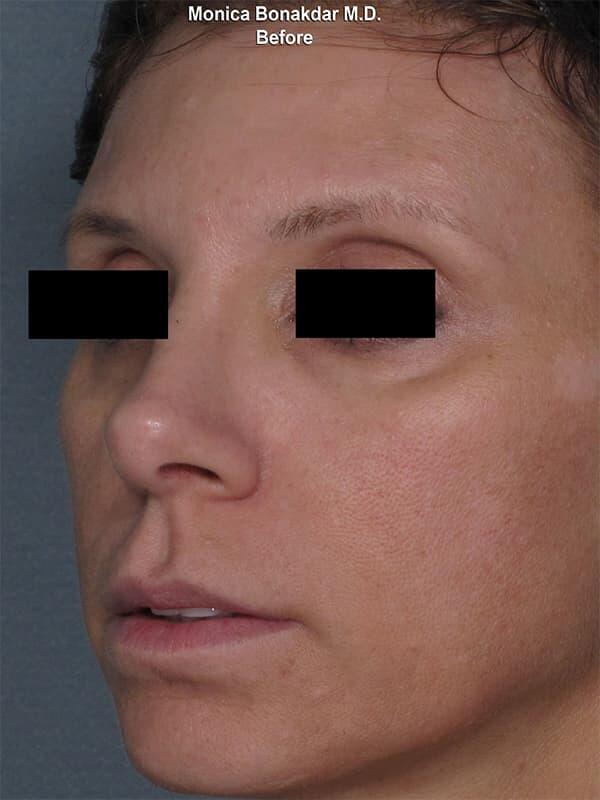 Sunken Eyes: Moderate Before & After Photo