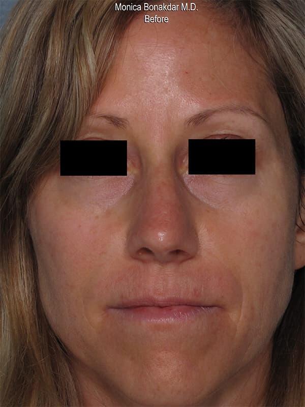 Sunken Eyes: Moderate Before & After Photo