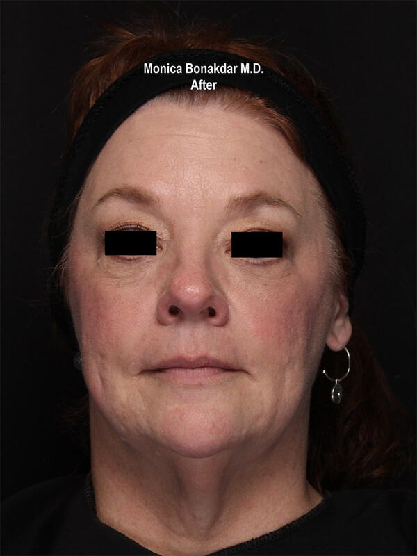 Sunken Eyes: Moderate Before & After Photo