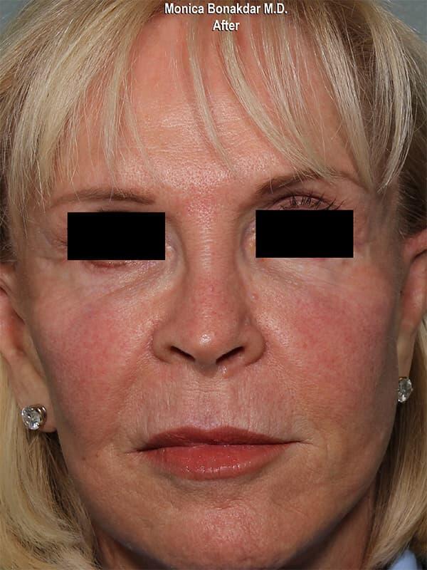 Sunken Eyes: Moderate Before & After Photo