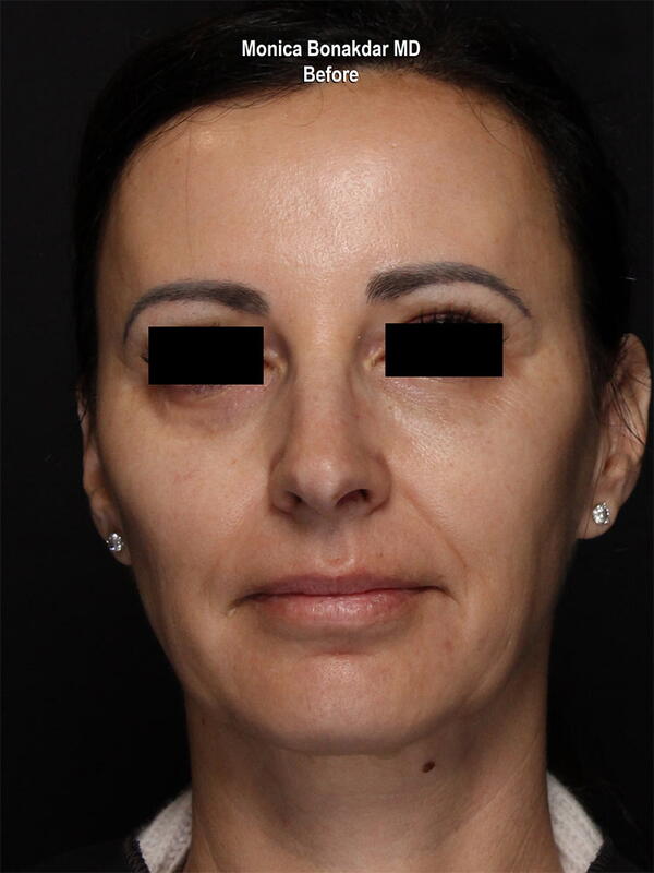 Sunken Eyes: Moderate Before & After Photo