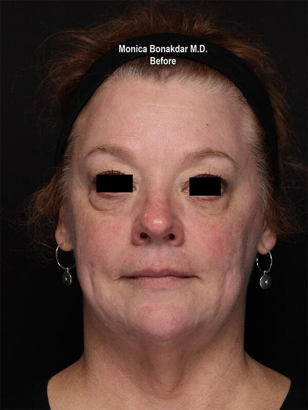 Sunken Eyes: Moderate Before & After Photo