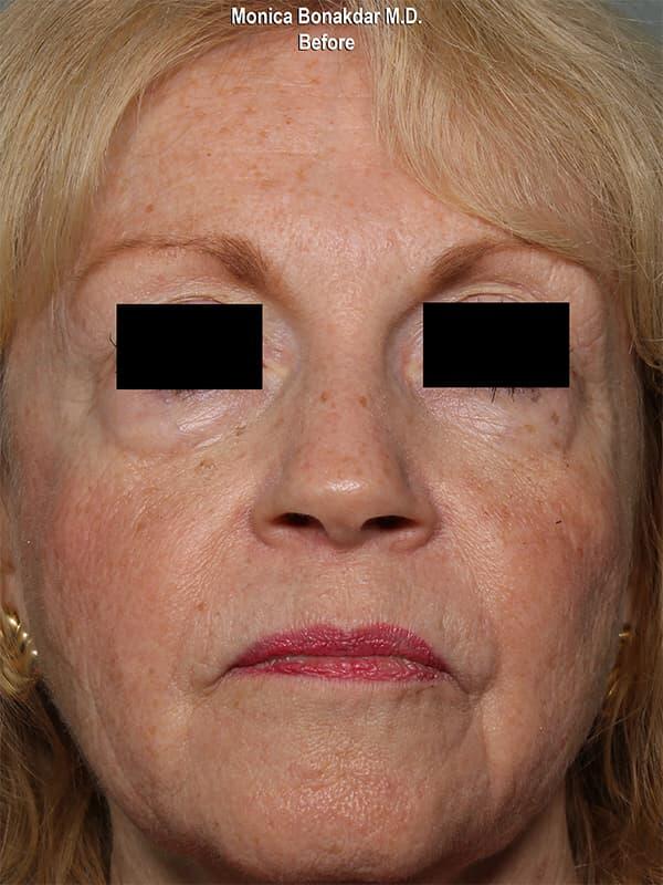 Sunken Eyes: Severe Before & After Photo