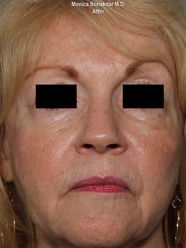 Sunken Eyes: Severe Before & After Photo