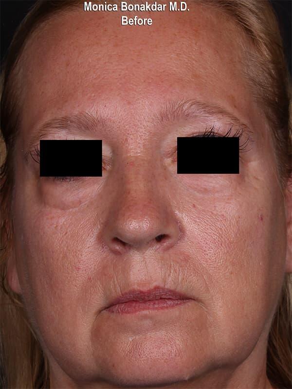 Sunken Eyes: Severe Before & After Photo