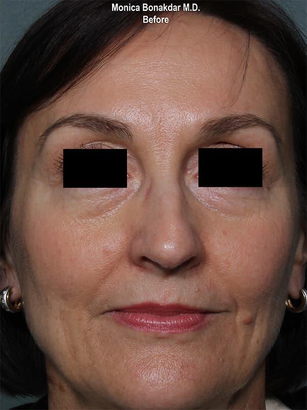 Sunken Eyes: Severe Before & After Photo