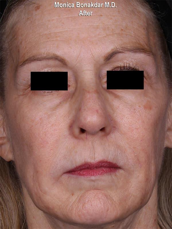 Sunken Eyes: Severe Before & After Photo