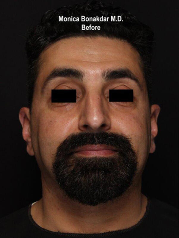 Upper Face and Temples Before & After Photo