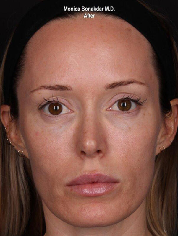 Upper Face and Temples Before & After Photo