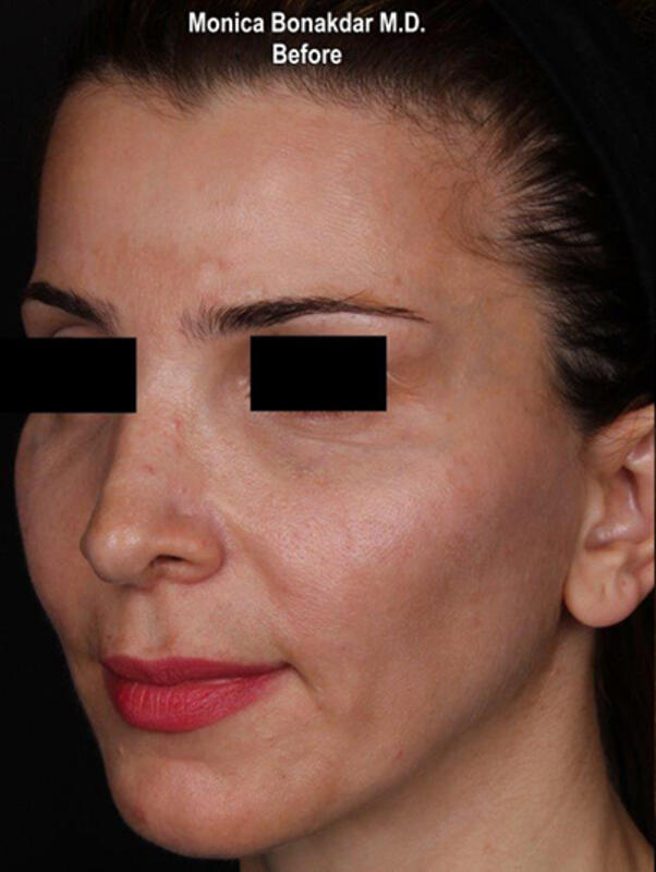 Upper Face and Temples Before & After Photo