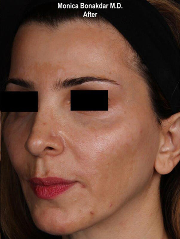 Upper Face and Temples Before & After Photo