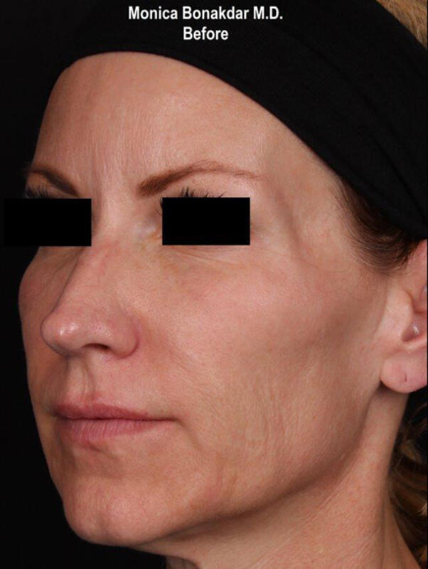 Upper Face and Temples Before & After Photo