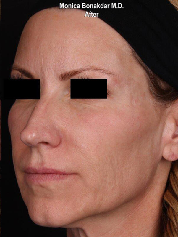 Upper Face and Temples Before & After Photo