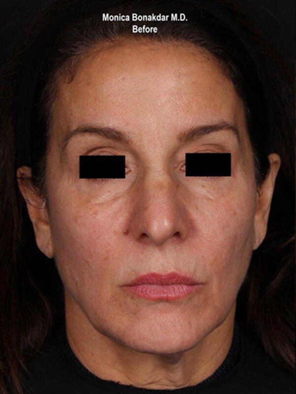 Upper Face and Temples Before & After Photo
