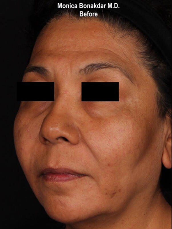 Upper Face and Temples Before & After Photo