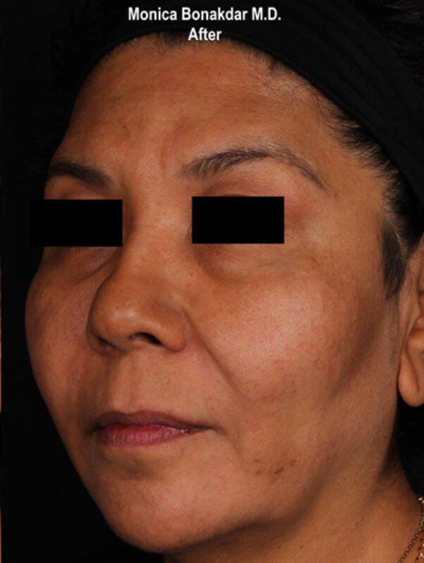 Upper Face and Temples Before & After Photo