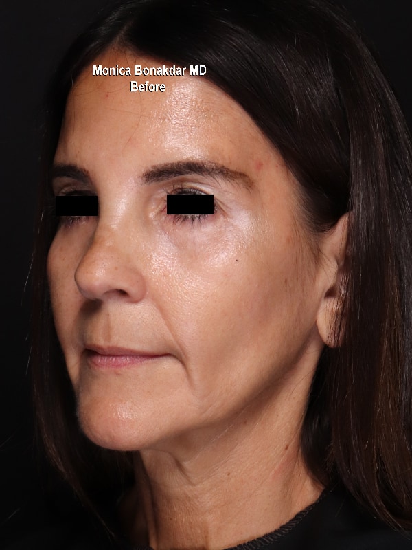 Upper Face and Temples Before & After Photo