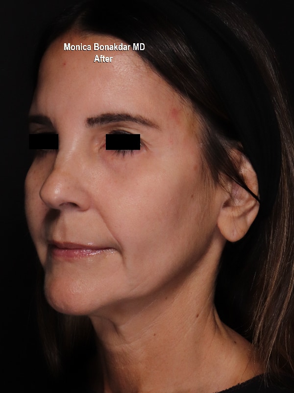 Upper Face and Temples Before & After Photo