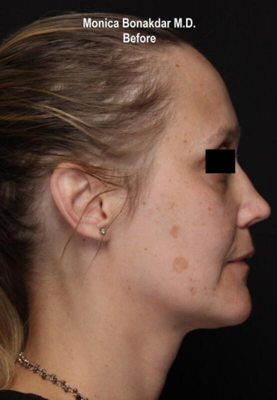 CO2 Laser Resurfacing Before & After Photo