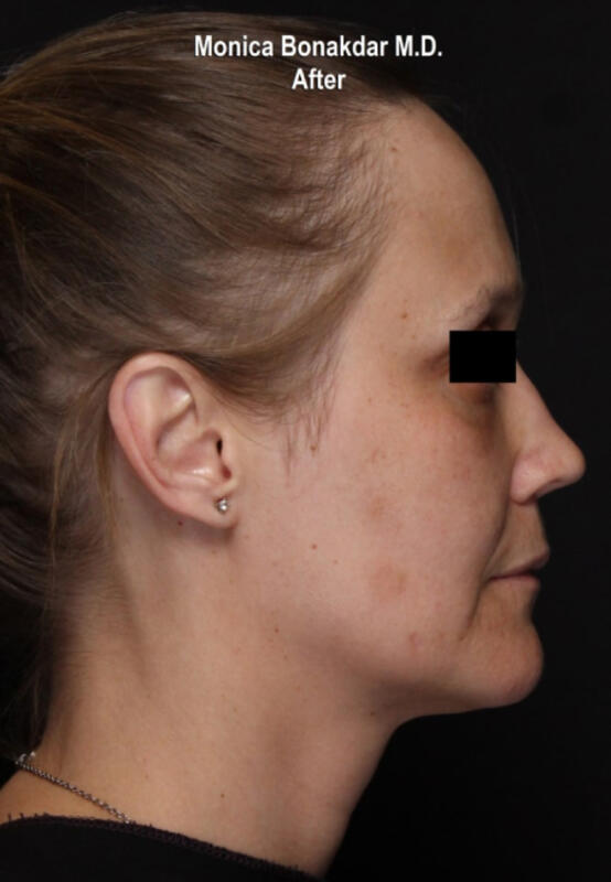 CO2 Laser Resurfacing Before & After Photo