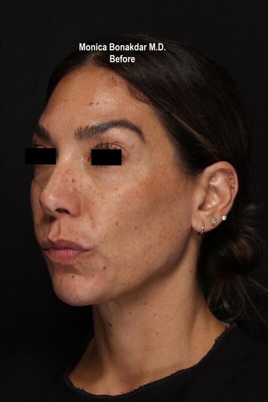 CO2 Laser Resurfacing Before & After Photo