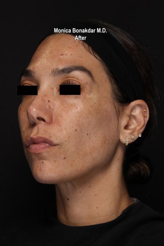 CO2 Laser Resurfacing Before & After Photo