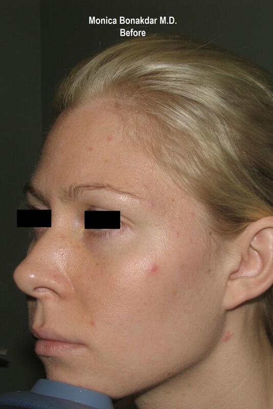 CO2 Laser Resurfacing Before & After Photo