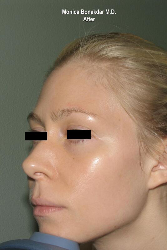 CO2 Laser Resurfacing Before & After Photo