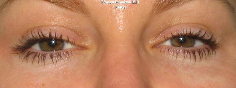 CO2 Laser Resurfacing Before & After Photo