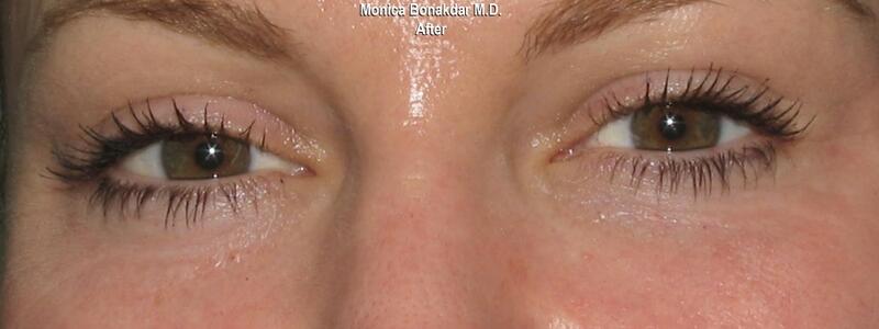 CO2 Laser Resurfacing Before & After Photo