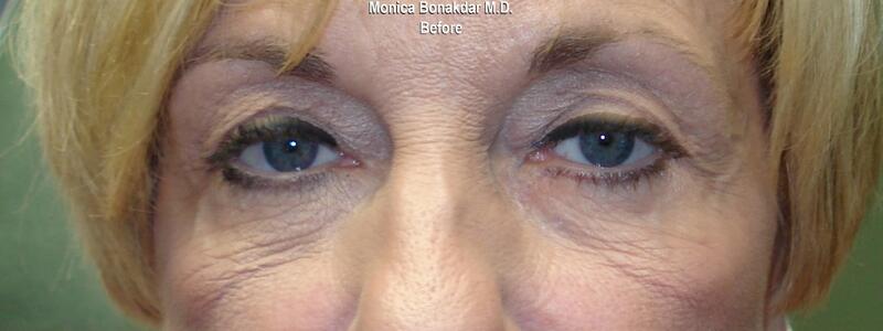 CO2 Laser Resurfacing Before & After Photo