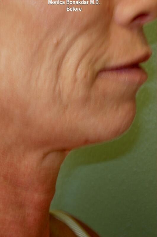 CO2 Laser Resurfacing Before & After Photo