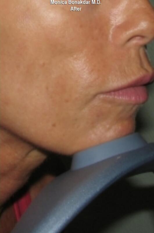 CO2 Laser Resurfacing Before & After Photo