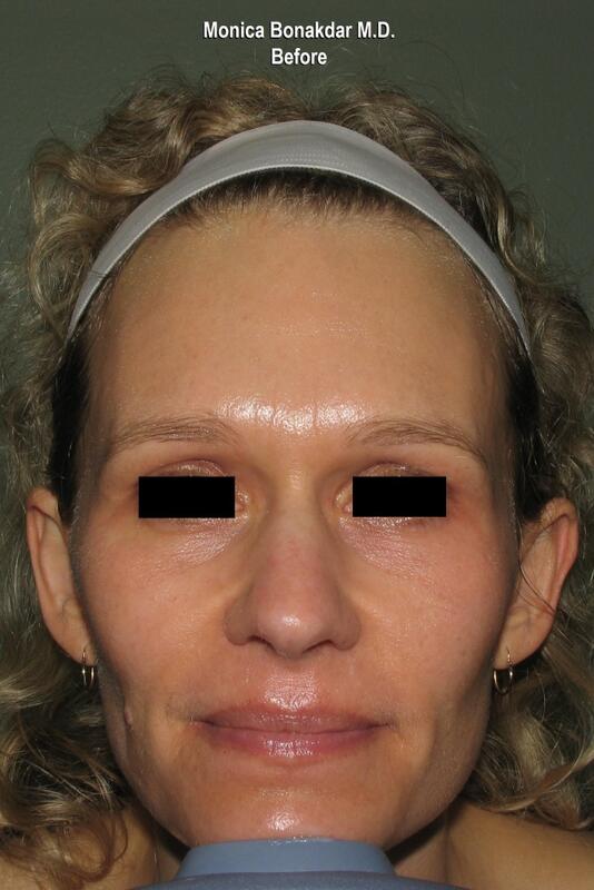 CO2 Laser Resurfacing Before & After Photo