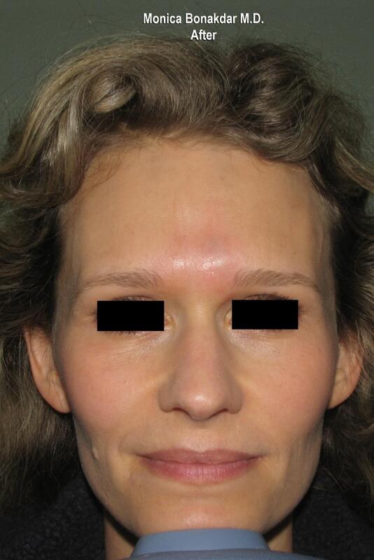 CO2 Laser Resurfacing Before & After Photo