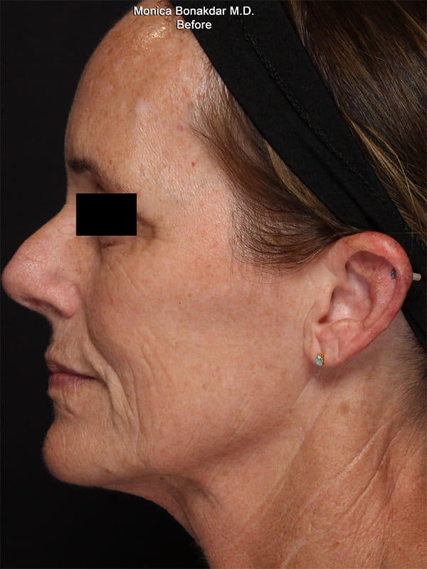 CoolPeel Before & After Photo