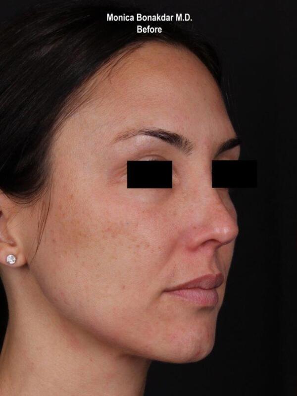 Intense Pulse Light - IPL Before & After Photo